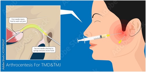 Temporomandibular Joint Disorders TMD TMJ treat pain displaced disc temporal bone locking bite plate plastic guard night Transcutaneous electrical nerve stimulation TENS Arthroscopy occlusal oral