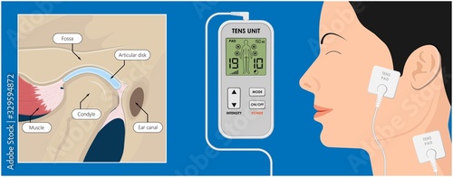 Temporomandibular Joint Disorders TMD TMJ treat pain displaced disc temporal bone locking bite plate plastic guard night Transcutaneous electrical nerve stimulation TENS Arthroscopy occlusal oral