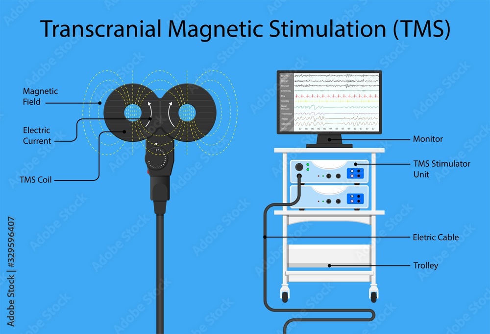 Transcranial stimulation TMS non invasive field obsessive