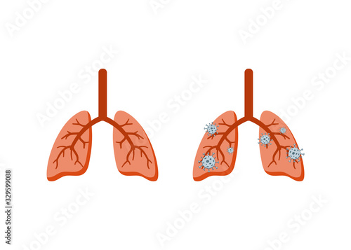 Healthy and diseased lungs Sick lungs infected with cancer virus bacteria coronovirus organ Theme of the medical brochure messages on the danger of lung diseases pneumonia infection cancer Vector