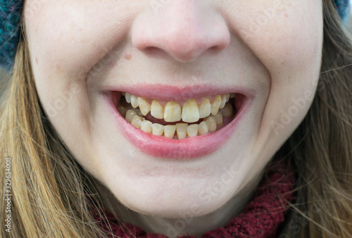 Yellow teeth of a girl, fluorosis. Smoker's problem teeth caused by fluoride, smoking, or coffee. Brown tooth enamel due to illness and drugs. Light skin and a wide smile. Natural photo
