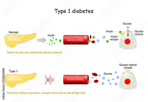 Types 1 of Diabetes Mellitus. photo