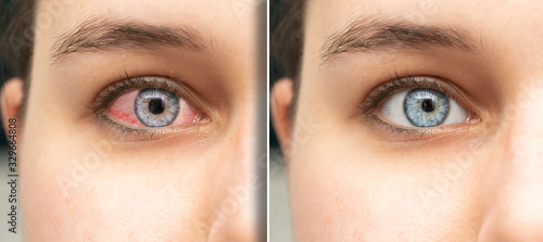 Detail of women red irritated eye before and after eyedrop treatment. Healthcare and eyecare concept... photo