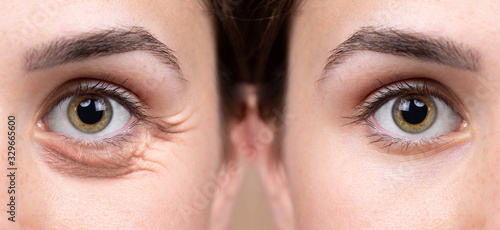 Fotografia Before and after eye bags and wrinkles removing comparison