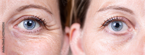 Collage comparison before and after beauty care. Closeup view of aged women eyes. .. photo
