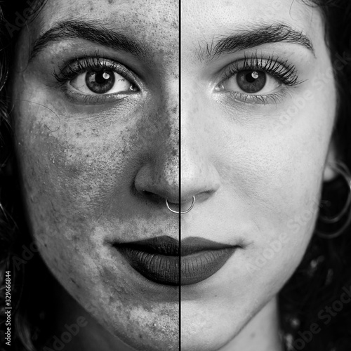Monochromatic collage comparing close up with and without applying ultraviolet light filter to detect skin damages. Young caucasian woman with piercing in nose. Medicine and healthcare concept...