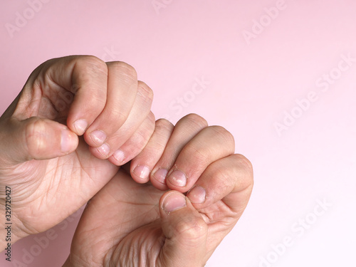 White spots on the nails of the male hand caused by a deficiency of calcium, zinc or poisoning by household chemicals on a pink background. This disease is called leukonychia. photo