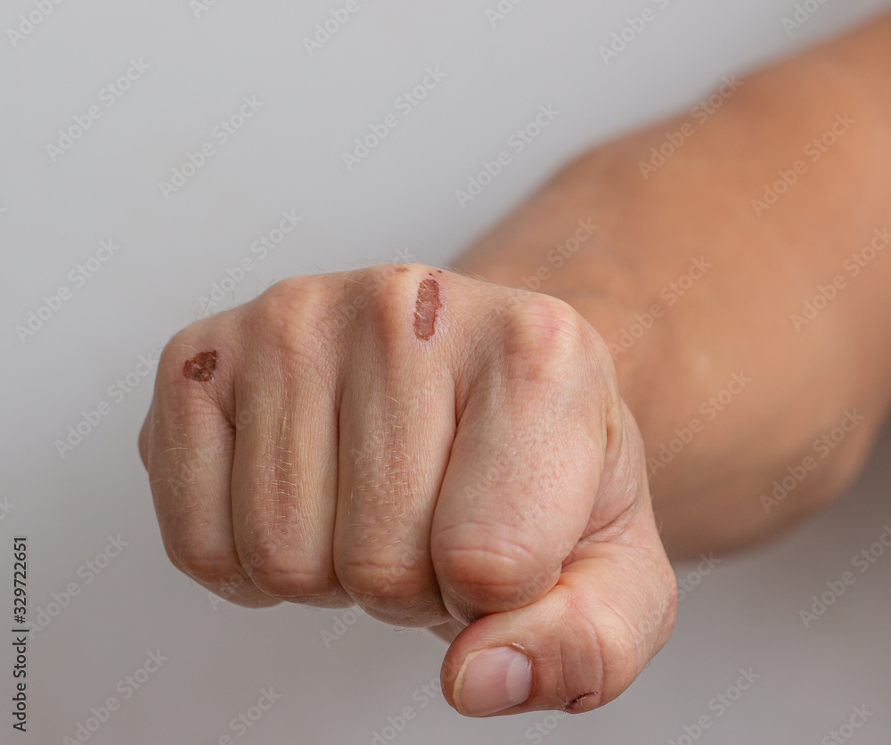 Fototapeta premium skin damage on the arm