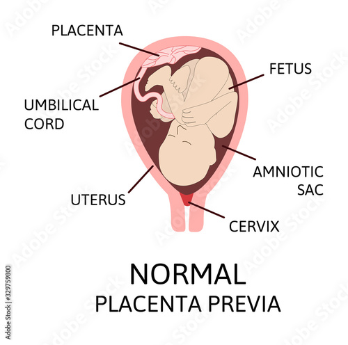 Different Placental Locations During Pregnancy. Major and Normal placenta previa, total and partial.
