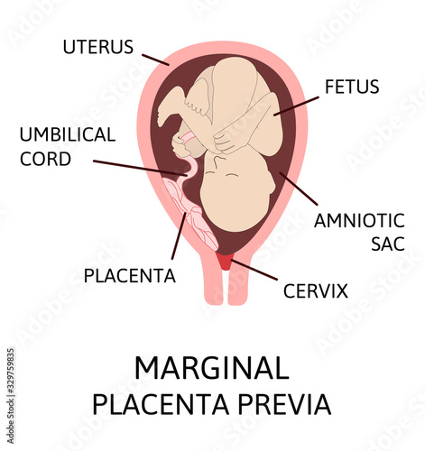 Different Placental Locations During Pregnancy. Major and Normal placenta previa, total and partial.