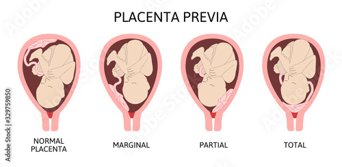 Different Placental Locations During Pregnancy. Major and Normal placenta previa, total and partial.