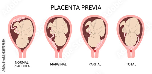 Different Placental Locations During Pregnancy. Major and Normal placenta previa, total and partial. photo