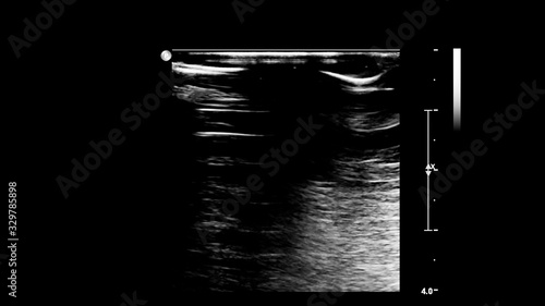 Ultrasound examination of blood vessels in grayscale mode.