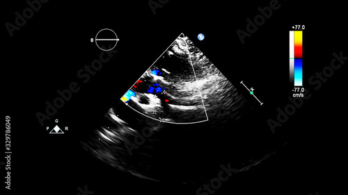 Fototapeta Naklejka Na Ścianę i Meble -  Image of the heart during transesophageal ultrasound with Doppler mode.