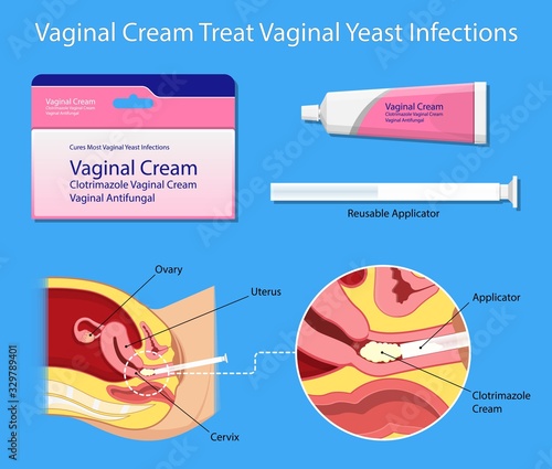 vaginal yeast infections treatment applicator symptoms natural remedies vulvovaginitis itchy hormone estrogen weakened immune system sex sexual contact vaginosis bacteria suppository