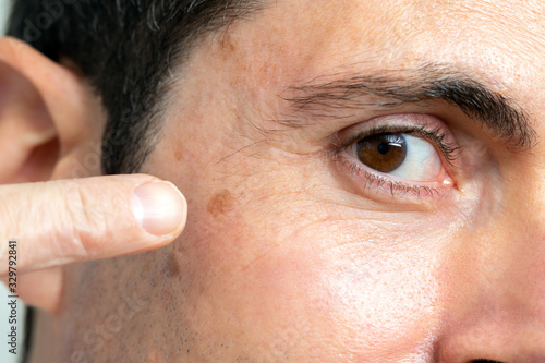 Detail of facial melanoma on middle aged man. photo
