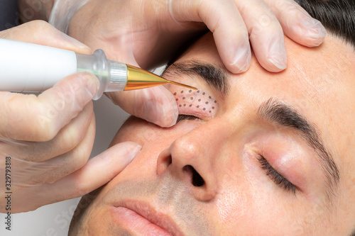 Middle aged man having laser plasma pen therapy on eyelids. photo