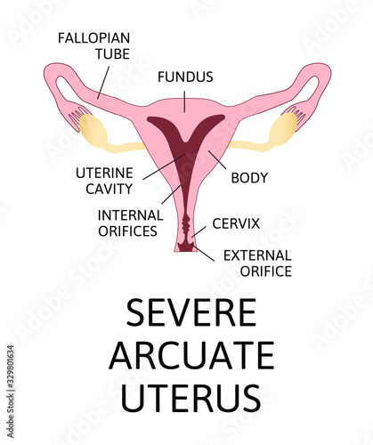 The shape of the uterus, the female reproductive organ. normal, mild arcuate, moderate, severe,