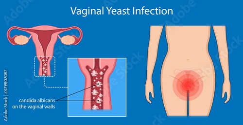 vaginal yeast infections treatment applicator symptoms natural remedies vulvovaginitis itchy hormone estrogen weakened immune system sex sexual contact vaginosis bacteria suppository