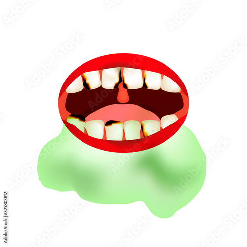 caries. Smell from the mouth. Halitosis. The structure of the teeth and oral cavity. Diseases of the teeth caries. Infographics. Vector illustration on isolated background.