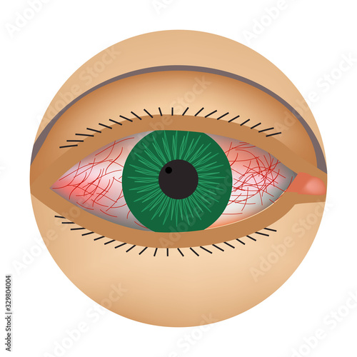 Redness of the eyes. Symptom of conjunctivitis, allergies, inflammation of the eyes. Eye redness icon. Infographics. Vector illustration on isolated background.