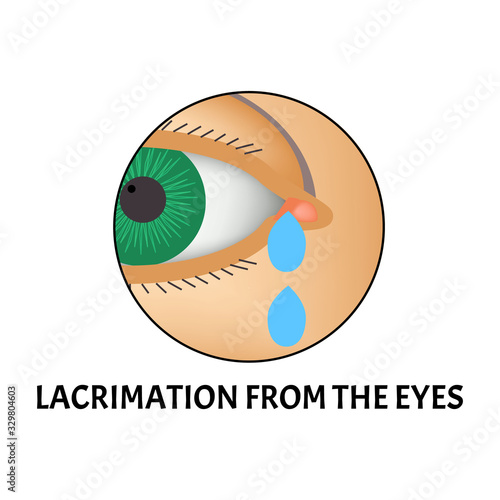 Lacrimation from the eyes. Symptom of conjunctivitis, allergies, inflammation of the eyes. Eye watering icon. Infographics. Vector illustration on isolated background.