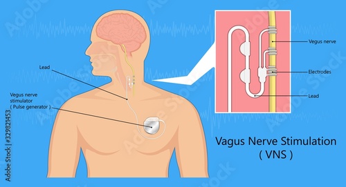 Vagus nerve stimulation VNS device depression electrical impulses treat epilepsy 
