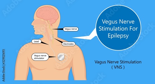 Vagus nerve stimulation VNS device depression electrical impulses treat epilepsy 