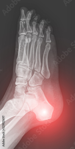 Human foot ankle and leg in x-ray, on gray background. The foot ankle is highlighted by red colour.