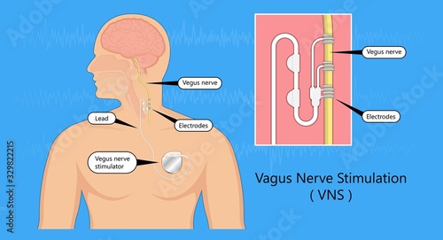 Vagus nerve stimulation device stimulate electrical impulse implantable stimulator treat epilepsy depression electroconvulsive therapy