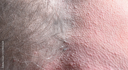 Male depilation. Half of male chest without hair after waxing. Close-up
