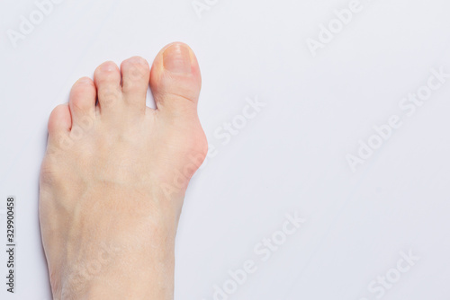 Bunion at side of a foot isolated on gray white background