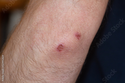 Close-up of the elbow of a man grazed