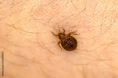 Bed Bug On Skin 