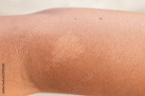 The arm with white birthmark.Birthmark on the arm of Southeast Asian child.