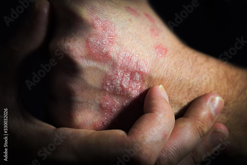 psoriasis is an autoimmune human disease. a man holds a hand at a psoriasis affected area of the skin
