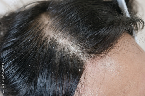 Close up of a hair dandruff , Black hair
