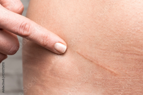 Fotografiet Appendicitis scar on woman's stomach