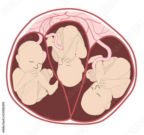 triplets in utero from an anterior. three fetuses in the uterus. Multiple pregnancy. risk factor. Separate amniotic sacks, one placenta. Three umbilical cords.