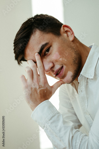 Junger Mann mit Pigmentstörung, Vitiligo im Lifestyle Portrait 