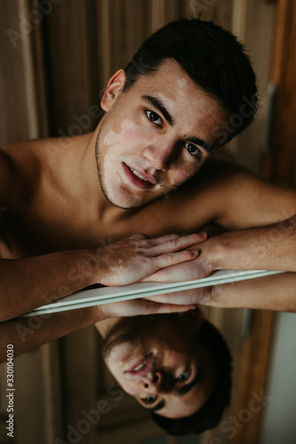 Junger Mann mit Pigmentstörung, Vitiligo im Lifestyle Portrait 