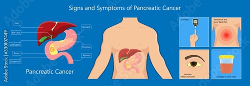 Whipple procedure pancreaticoduodenectomy Pancreatic cancer treatment total pancreatectomy Small bowel surgical  photo