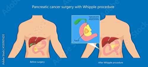 Whipple procedure pancreaticoduodenectomy Pancreatic cancer treatment total pancreatectomy Small bowel surgical 