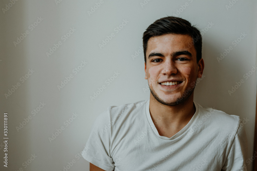 Junger Mann mit Pigmentstörung, Vitiligo im Lifestyle Portrait Junger Mann mit Pigmentstörung, Vitiligo im Lifestyle Portrait