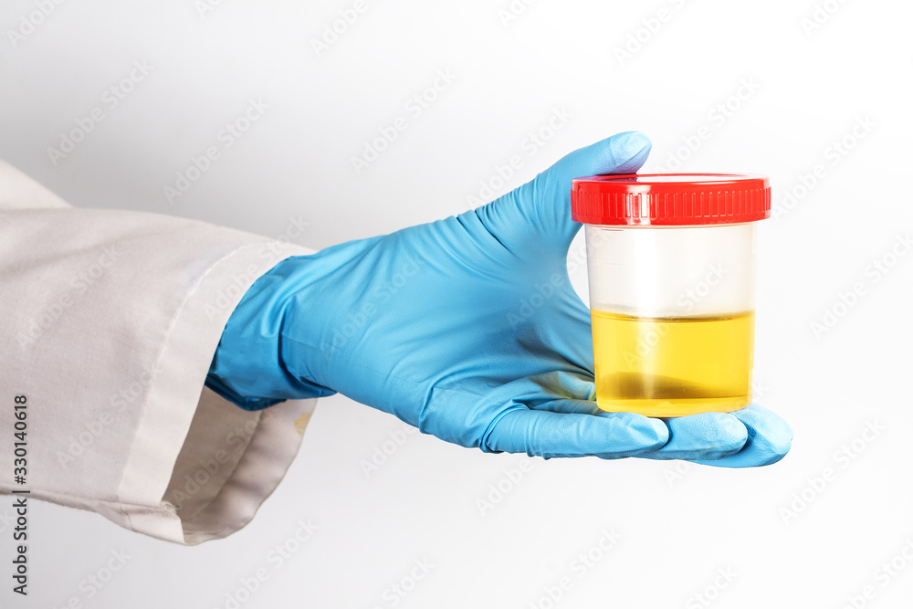 a doctor in a white coat and blue gloves holds a plastic can of urine in his hand. urine tests for virus, alcohol, pregnancy, drugs, and diseases a doctor in a white coat and blue gloves holds a plastic can of urine in his hand. urine tests for virus, alcohol, pregnancy, drugs, and diseases