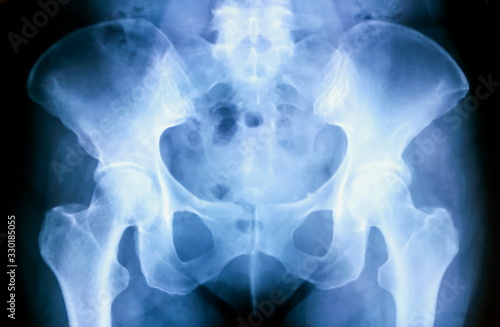 Foto X-ray of pelvic bones anatomy