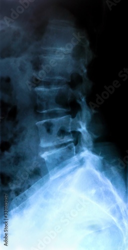 X-ray of the bones of the human lower lumbar part of the vertebral column photo