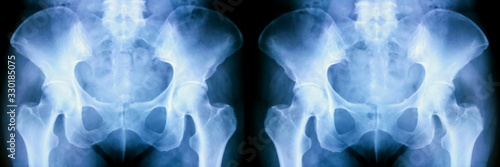 Set of X-ray of human pelvic bones