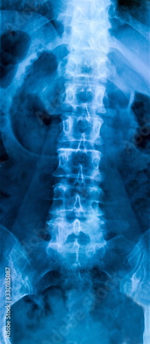 X-ray of the bones of the human lower lumbar part of the vertebral column photo