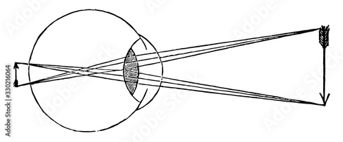 Cornea too Concave on Eye, vintage illustration.